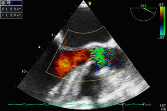 Stenoza valvula aortalis u color doppler
