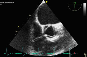Valvula aortalis, normalan nalaz